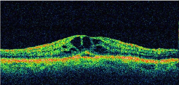 Cystoid Macular Edema
