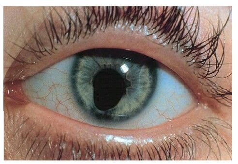 IRIS COLONOMA