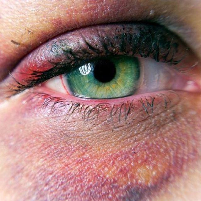 Ocular Trauma